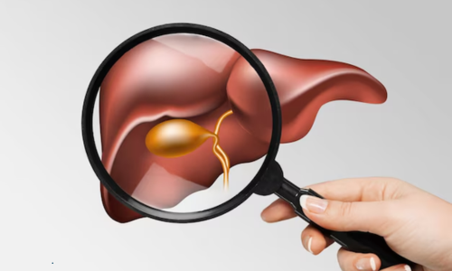 How Do Hepatologists Treat Fatty Liver Disease Effectively