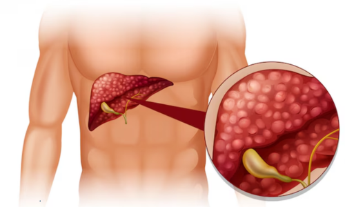 Understanding Cirrhosis, Causes, Stages, and Modern Treatments