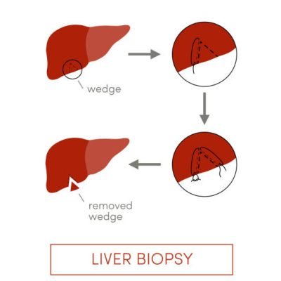 Liver-biopsy-dr-harikumar